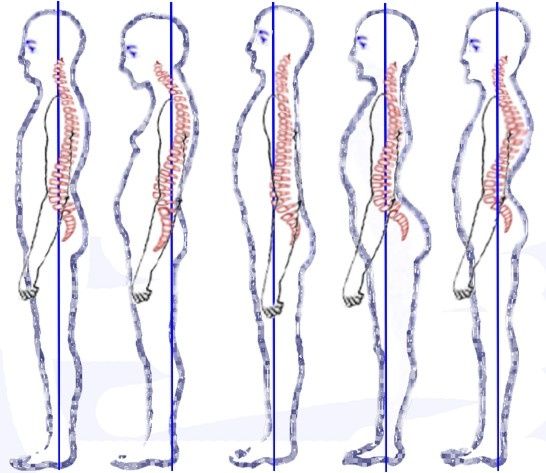 Posture_types_vertebral_column