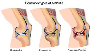 arthritis_commontypes