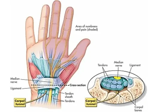 carpal tunnel syndrome