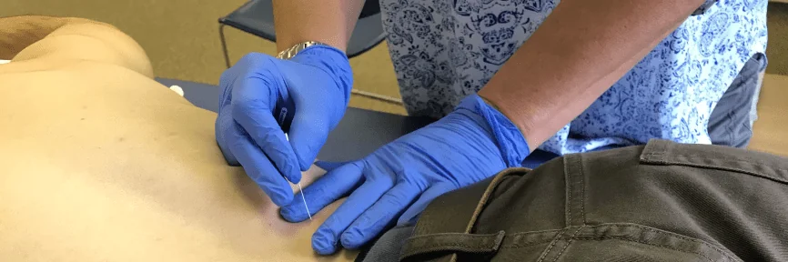Dry needling lower back physical therapy